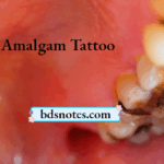 Soft Tissue Amalgam Deposit