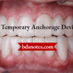 Temporary Anchorage Devices