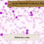 Acute Myeloid Leukemia Diagnosis