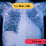 Cardiomegaly