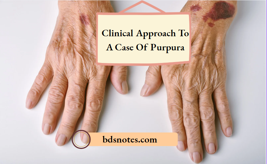 Clinical Approach To A Case Of Purpura