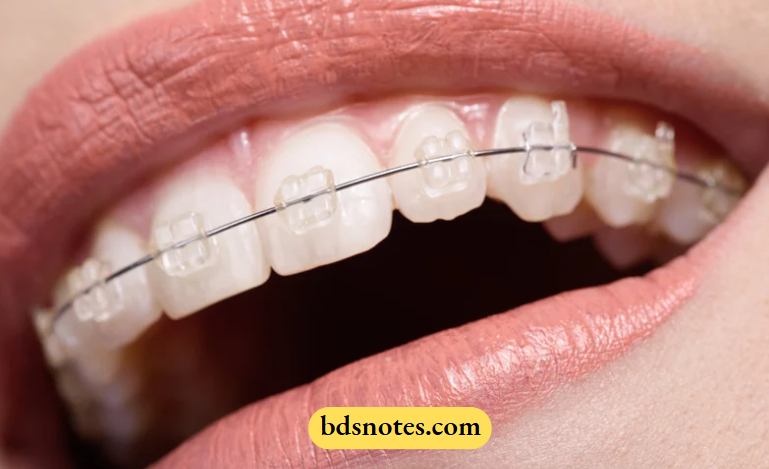 Comparative Analysis Of Anchorage Systems