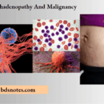 Lymphadenopathy And Malignancy