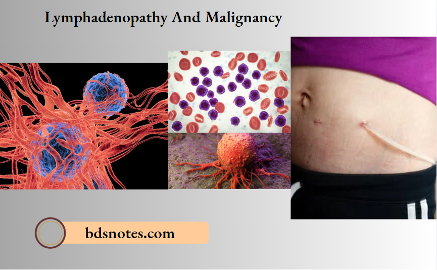 Lymphadenopathy And Malignancy