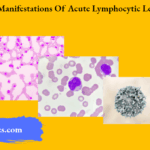 Oral Manifestations Of Acute Lymphocytic Leukemia