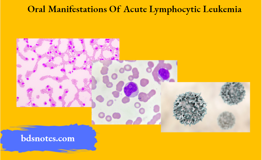 Oral Manifestations Of Acute Lymphocytic Leukemia