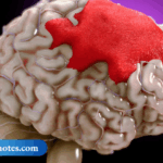 Understanding Hemorrhage