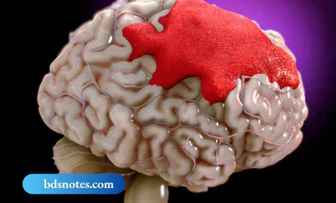 Understanding Hemorrhage